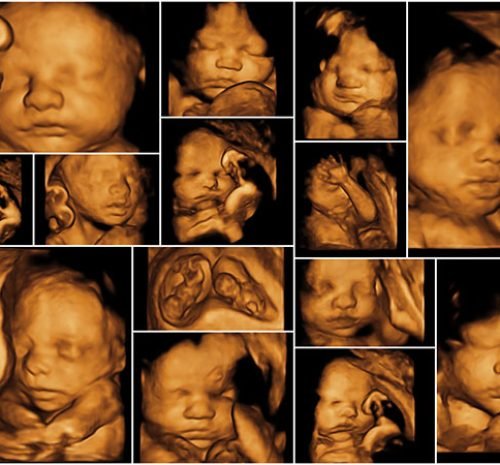 SONOGRAPHY-3D-4D-USG
